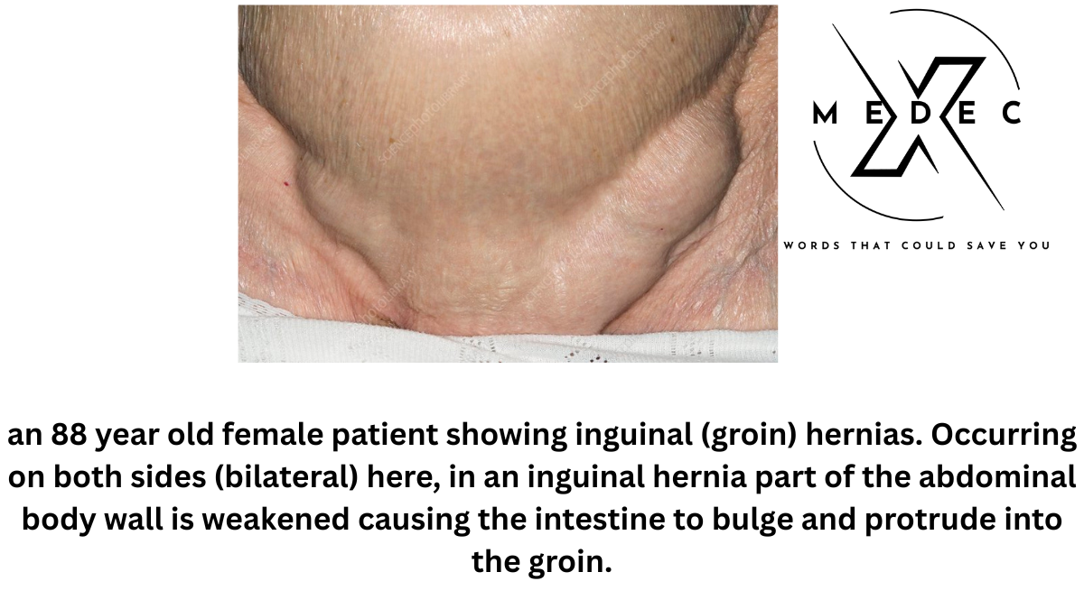 Hernia Symptoms and Treatment:The Ultimate Comprehensive 7-Part Guide to Types, Causes, Surgery, and Prevention 1 Hernia Symptoms and Treatment